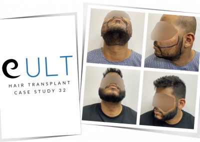 Hair Transplant Results at Cult Aesthetics 32