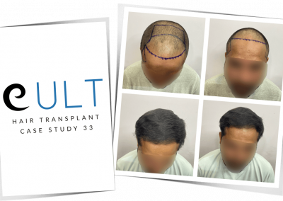 Hair Transplant Results at Cult Aesthetics 33