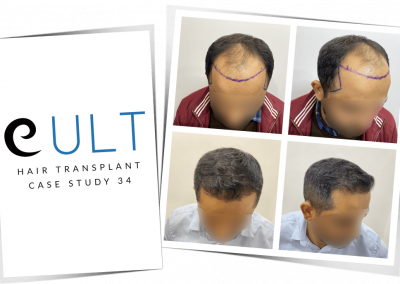 Hair Transplant Results at Cult Aesthetics 34