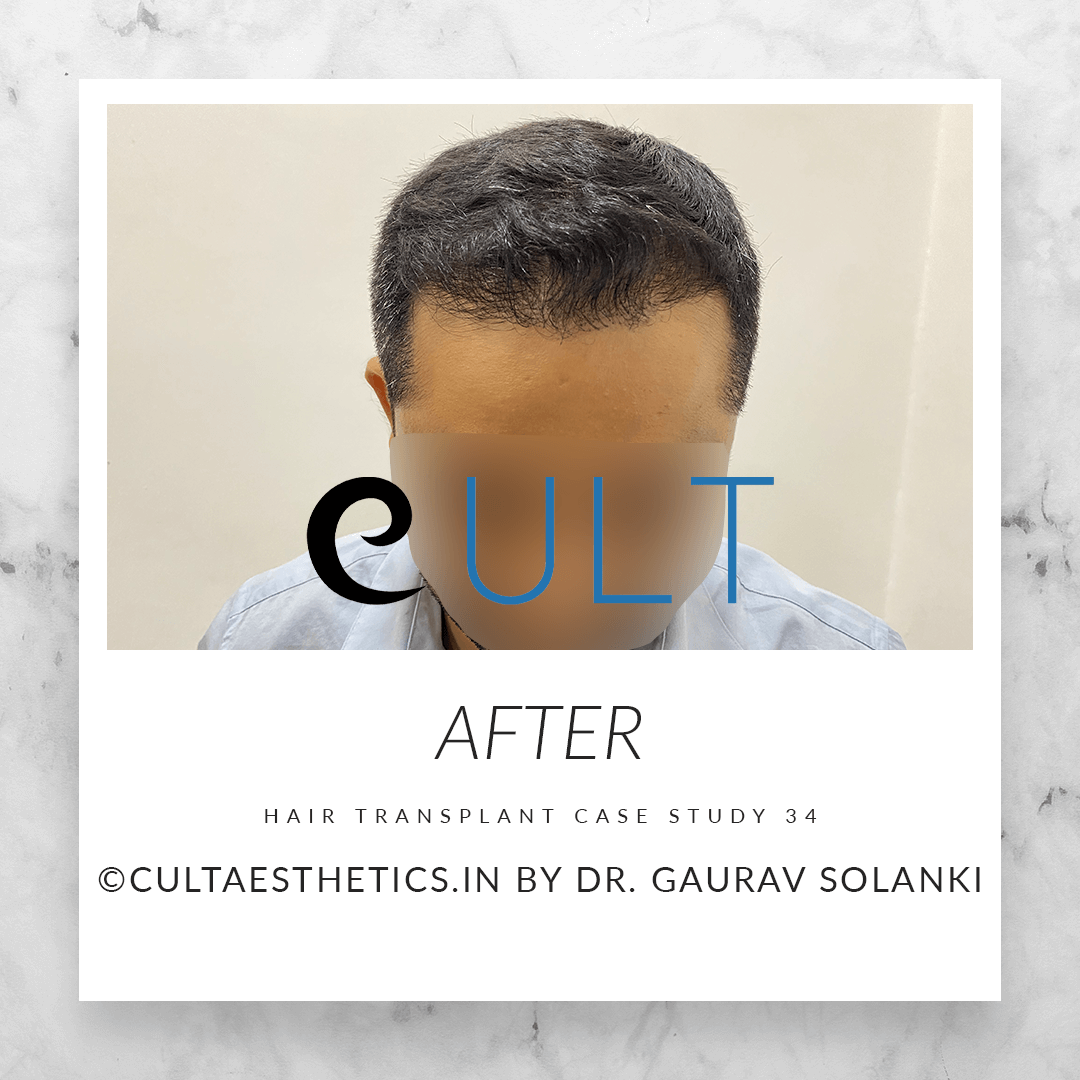 Hair Transplant Results at Cult Aesthetics 34