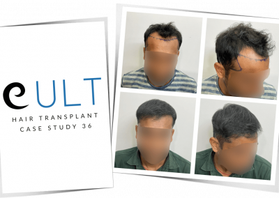 Hair Transplant Results at Cult Aesthetics 36