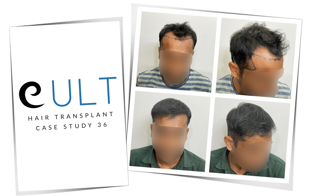 Hair Transplant Results at Cult Aesthetics 36