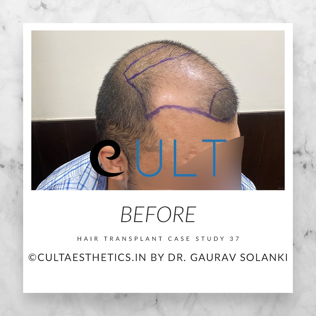 Hair Transplant Results at Cult Aesthetics 37