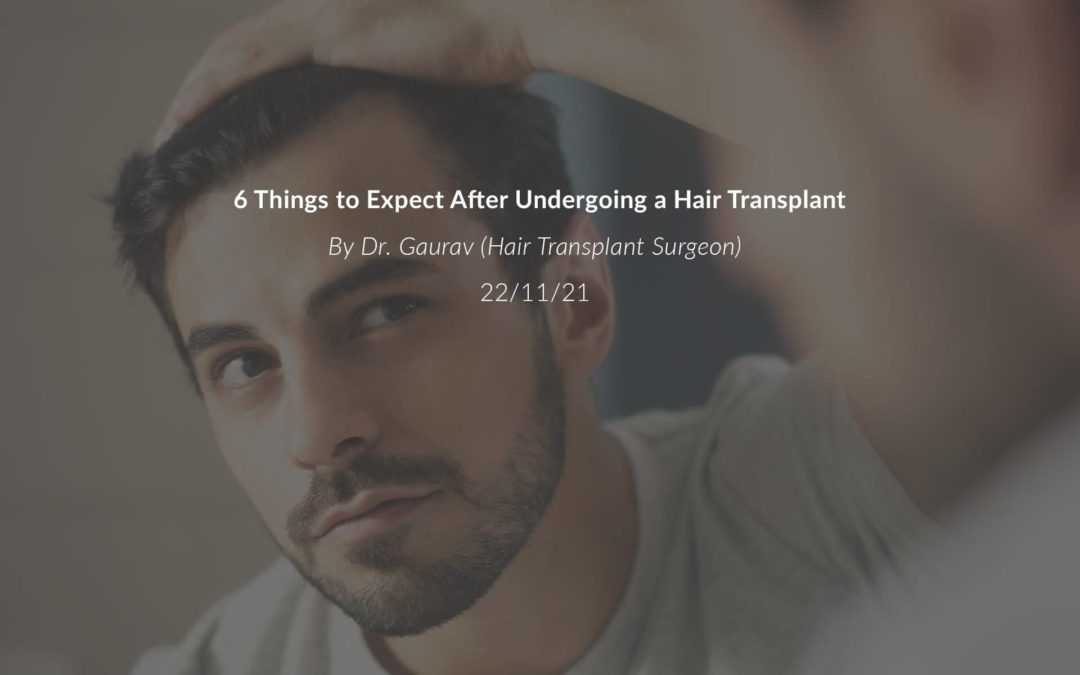 6 Things to Expect After Undergoing a Hair Transplant!