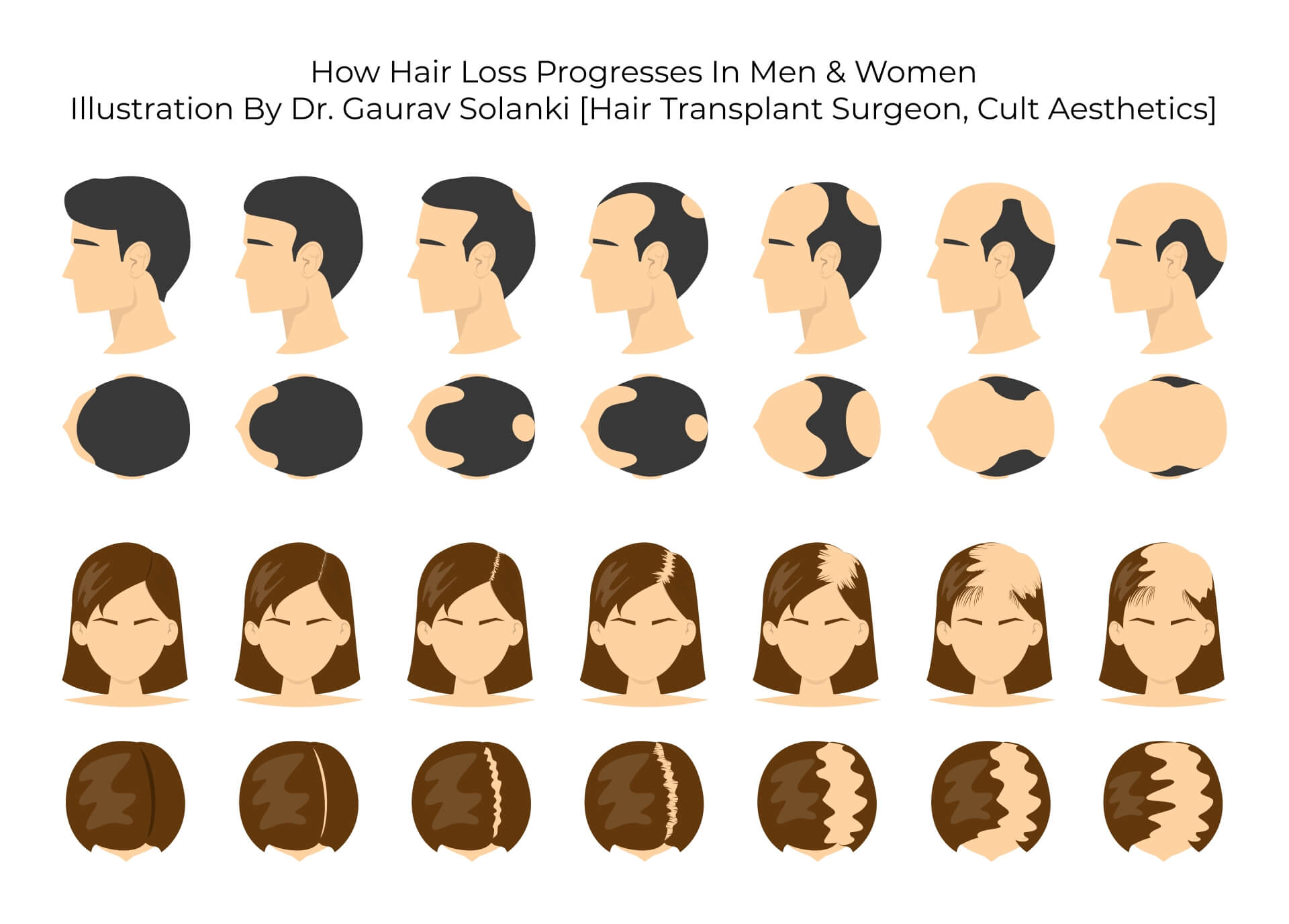 Hair Loss Progression in Men and Women