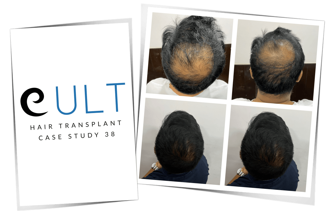 Hair Transplant Results at Cult Aesthetics 38