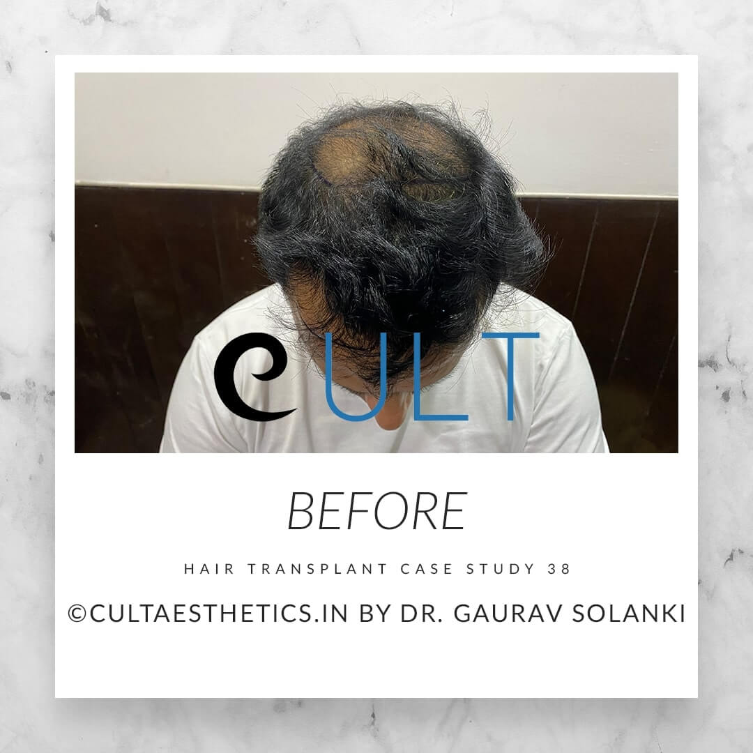 Hair Transplant Results at Cult Aesthetics 38