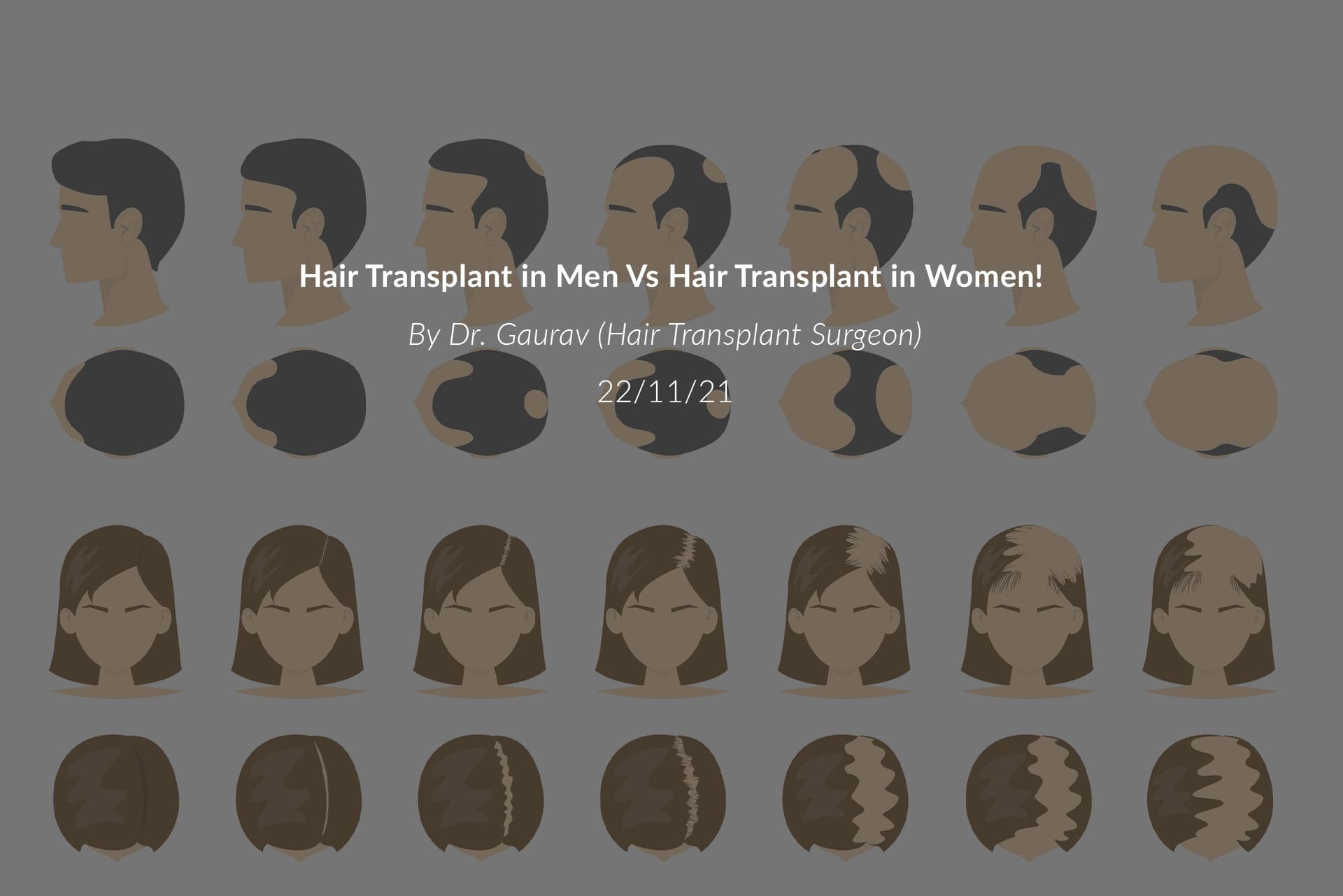 Hair Transplant in Men Vs Hair Transplant in Women!