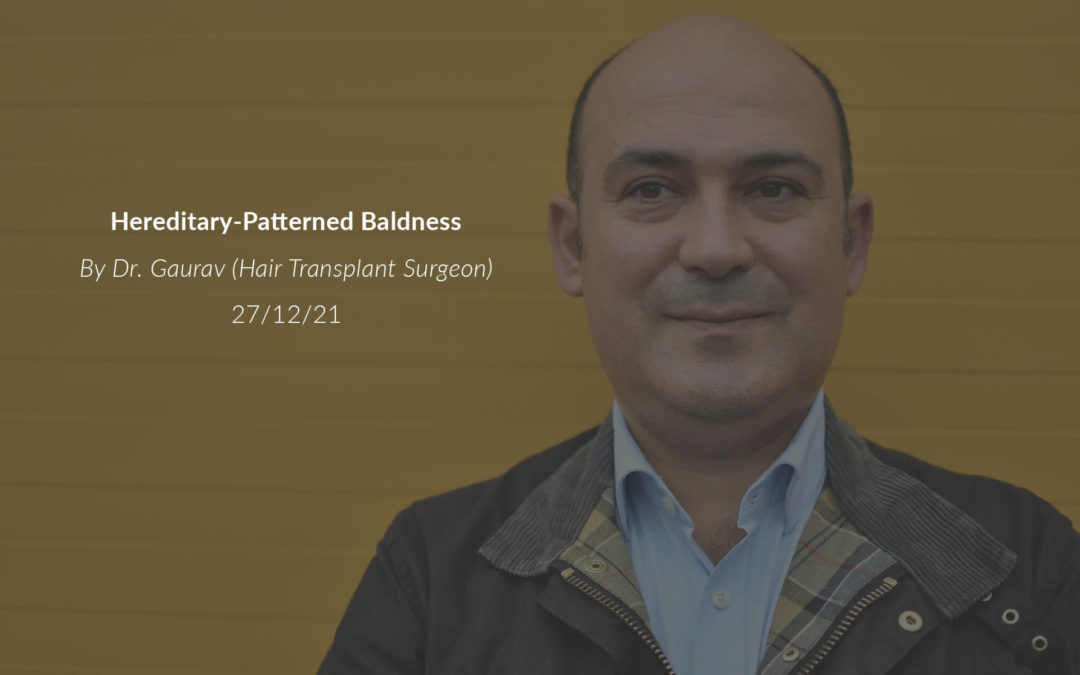 Hereditary-Patterned Baldness Explained By Dr. Gaurav