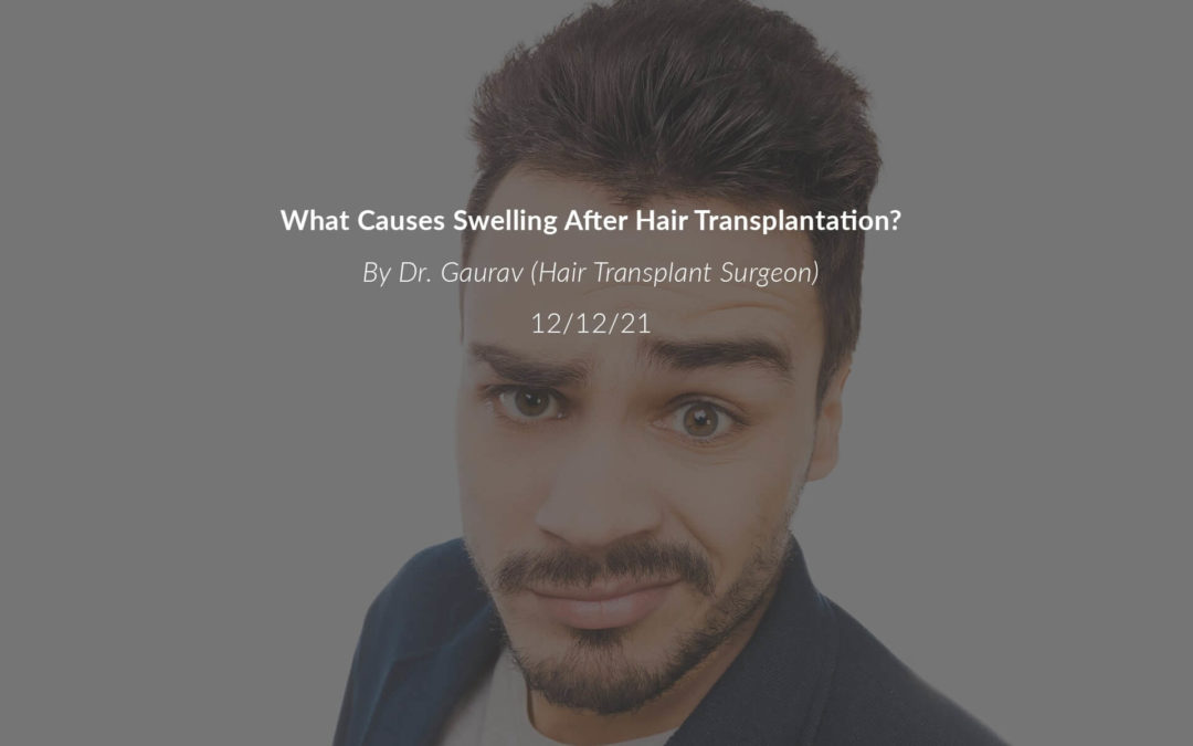 What Causes Swelling After a Hair Transplant?