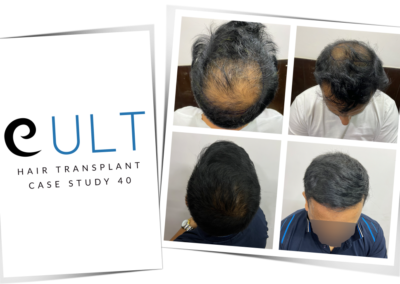 Hair Transplant Results at Cult Aesthetics 40