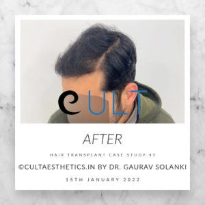 Hair Transplant Case 41 - After Results at Cult Aesthetics Gurgaon