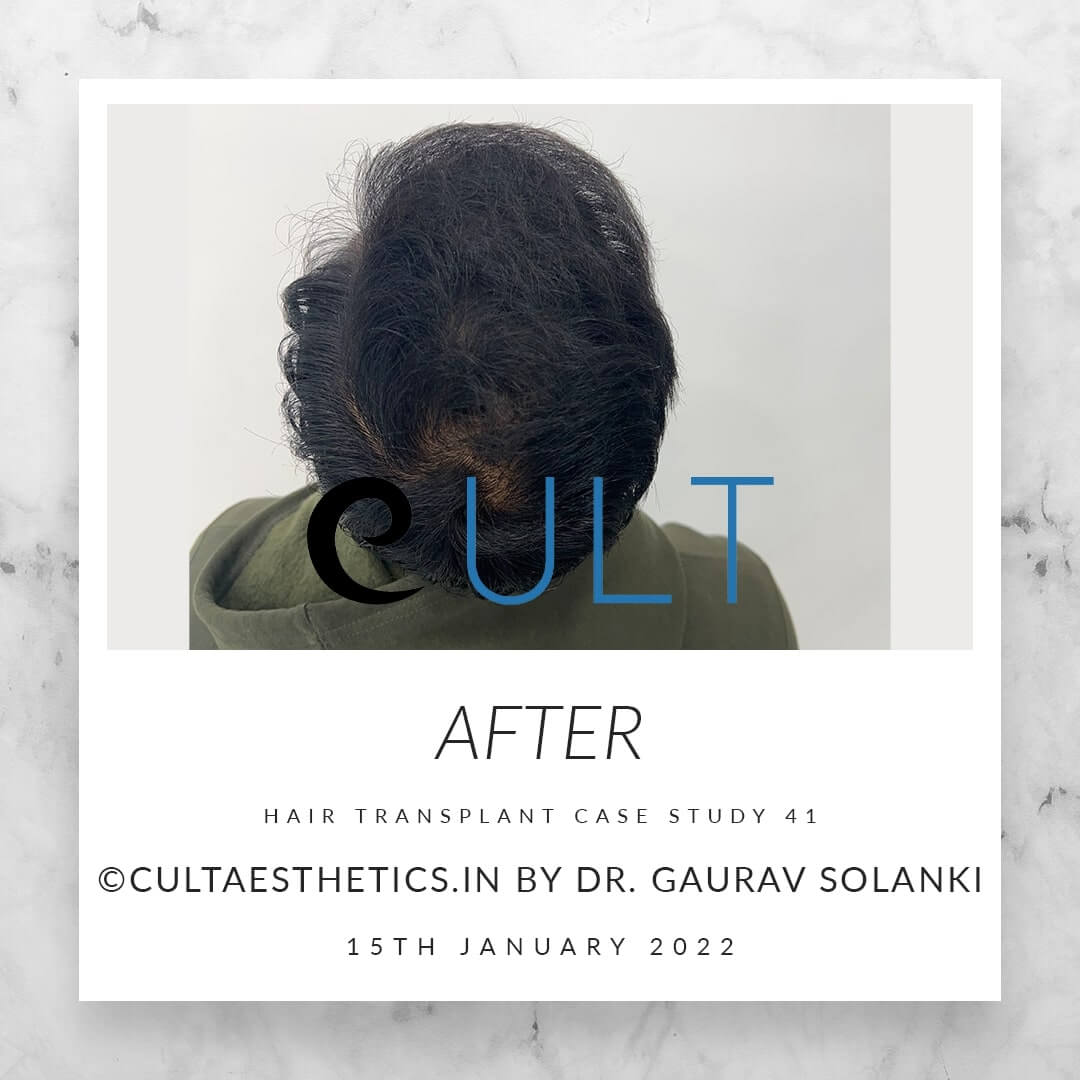 Hair Transplant Results at Cult Aesthetics 41
