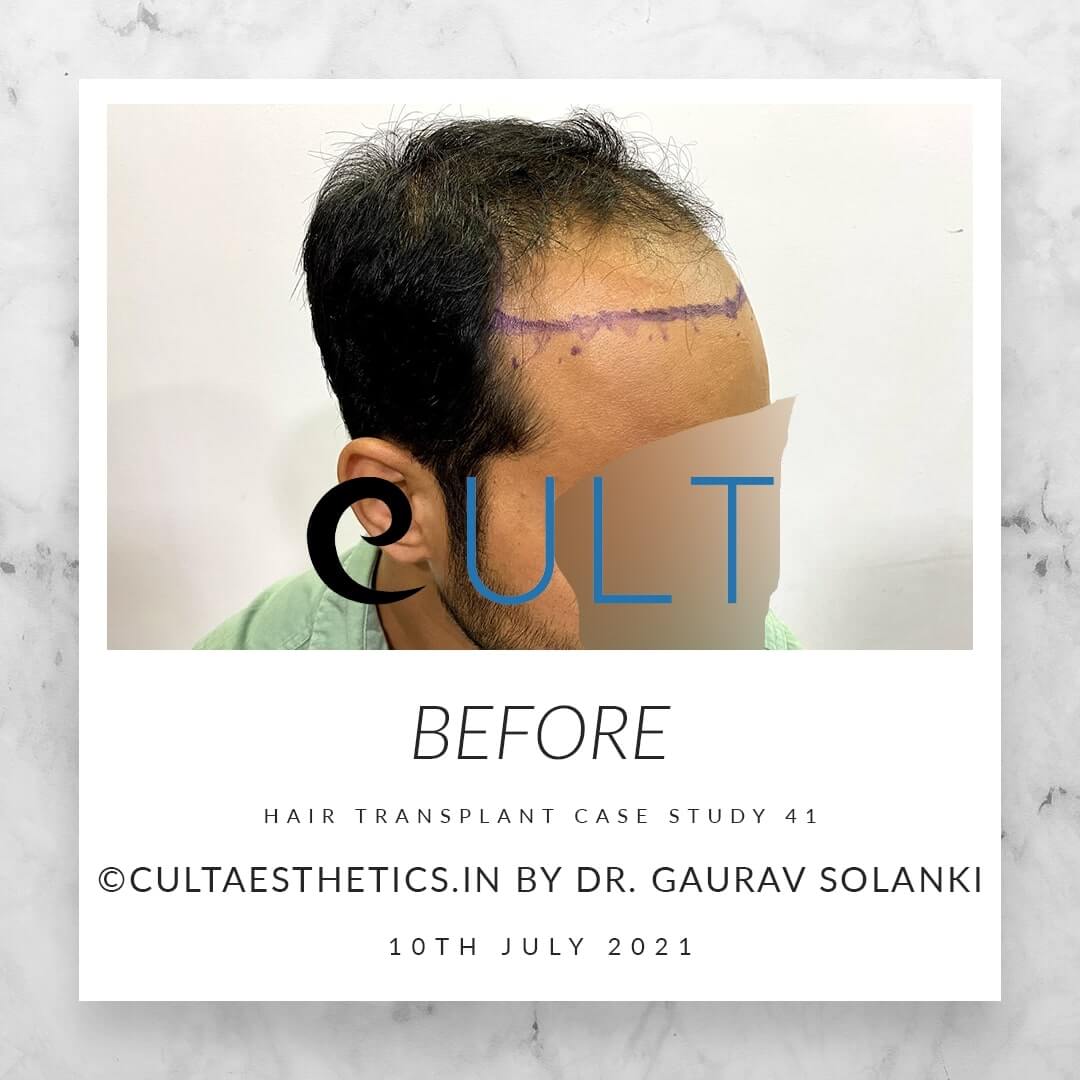 Hair Transplant Results at Cult Aesthetics 41
