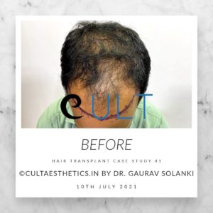 Hair Transplant Case 41 - Before Treatment at Cult Aesthetics Gurgaon