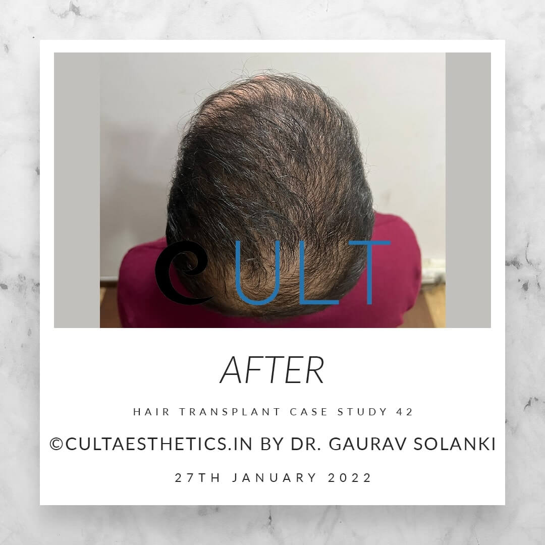 Hair Transplant Results at Cult Aesthetics 42