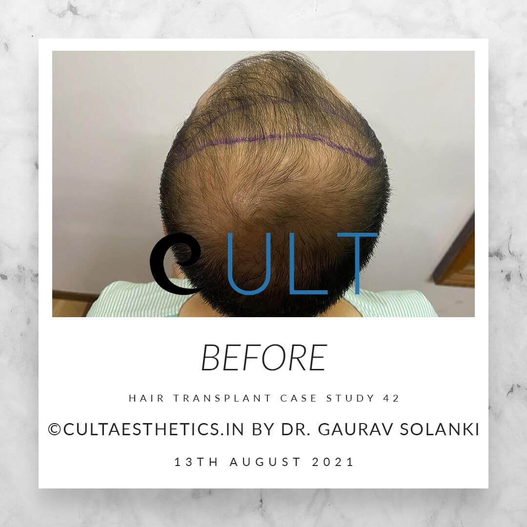 Hair Transplant Results at Cult Aesthetics 42