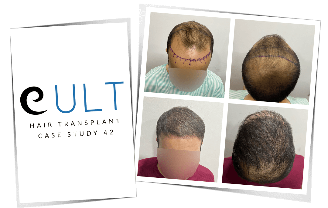 Hair Transplant Case Study 42 | Cult Aesthetics