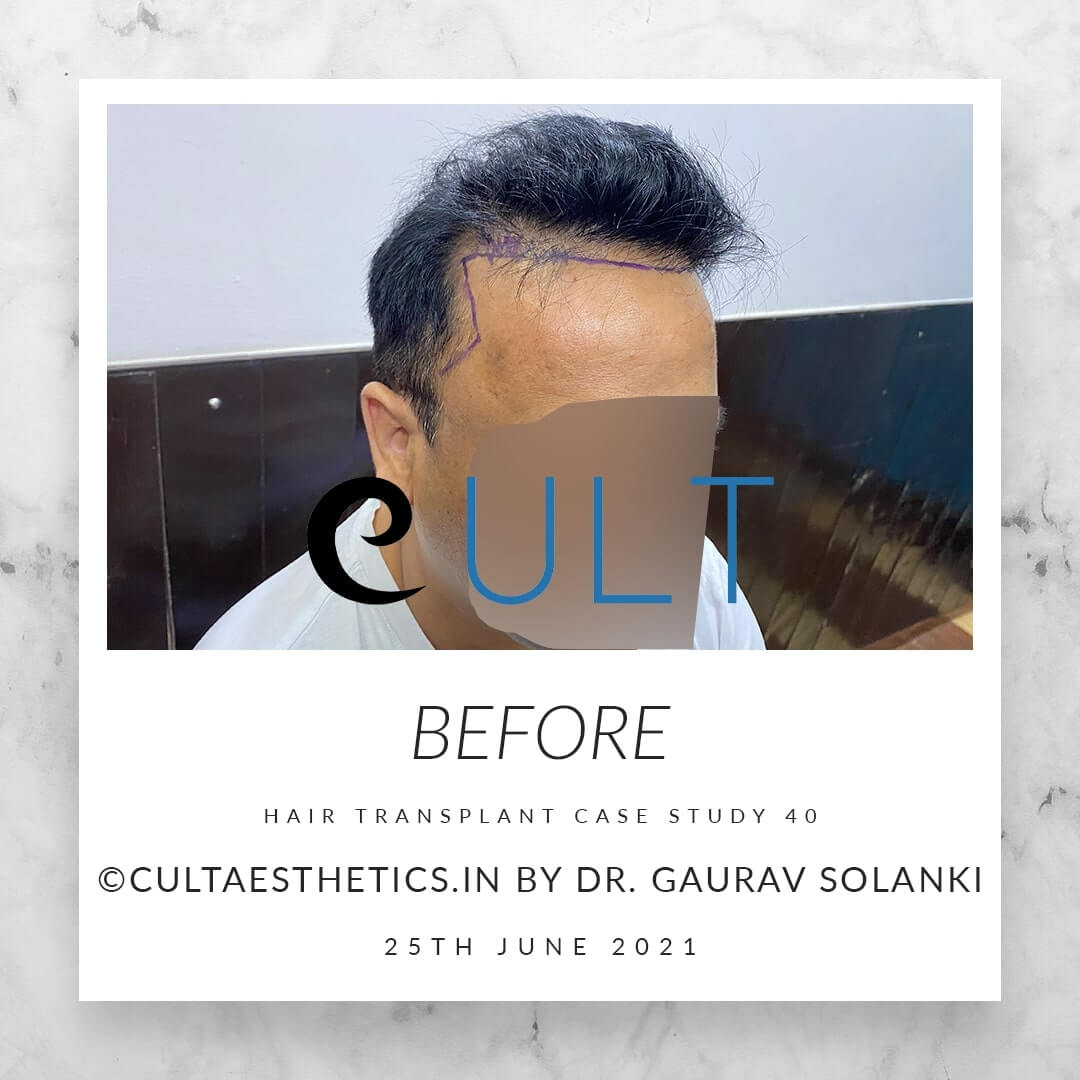 Hair Transplant Results at Cult Aesthetics 40