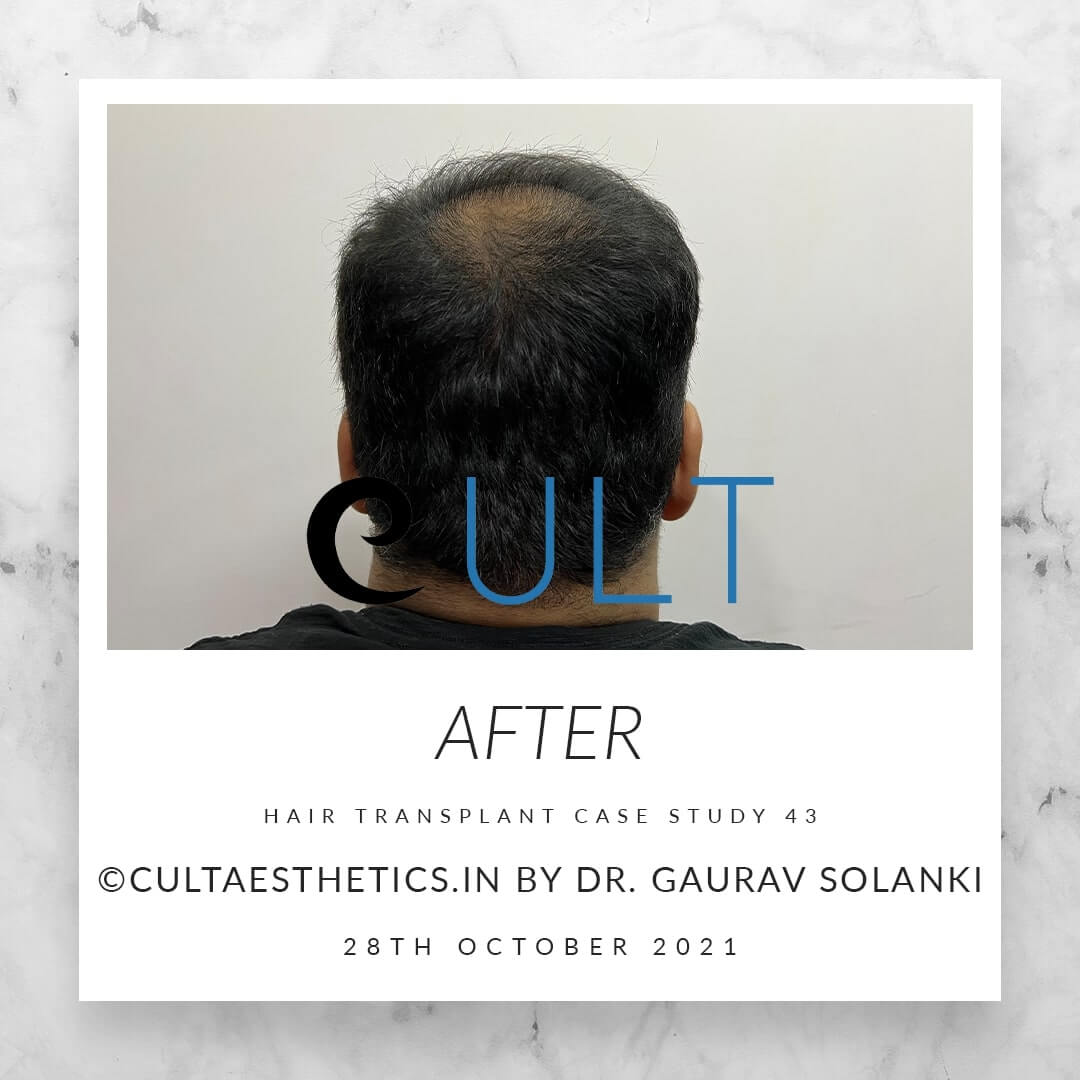 Hair Transplant Results at Cult Aesthetics 43