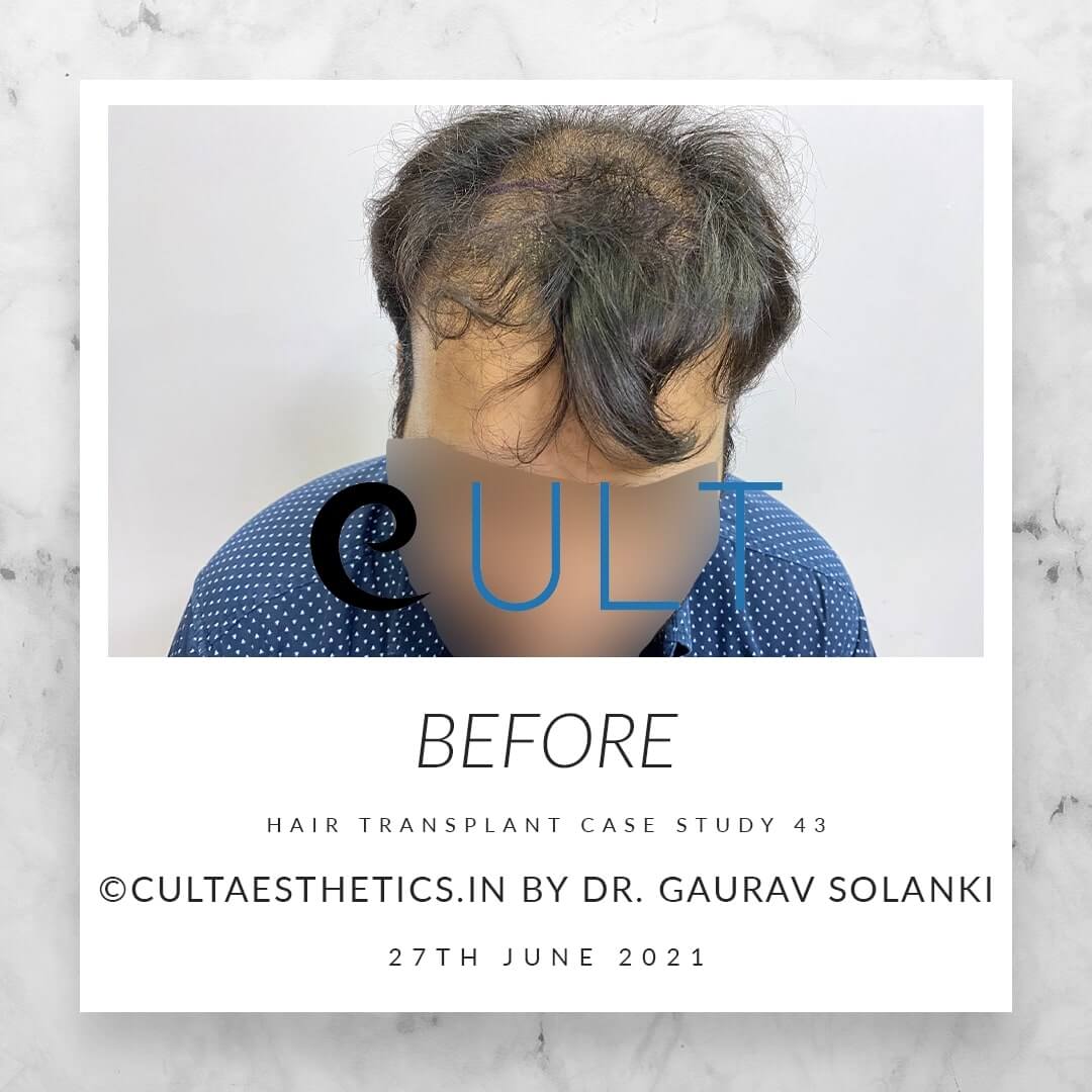 Hair Transplant Results at Cult Aesthetics 43