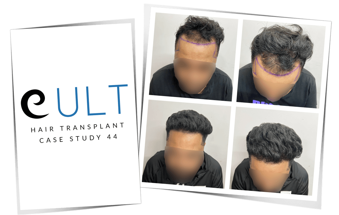 Hair Transplant Results at Cult Aesthetics 44