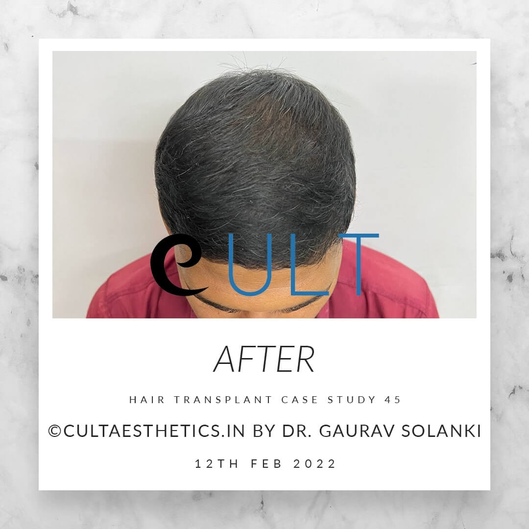 Hair Transplant Results at Cult Aesthetics 45