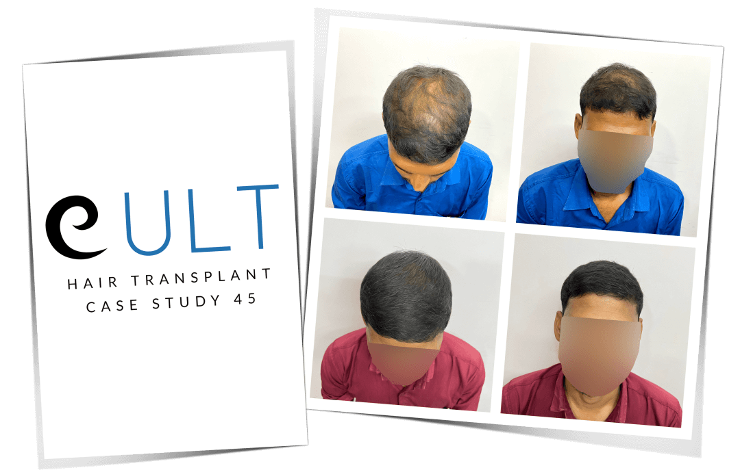 Hair Transplant Results at Cult Aesthetics 45
