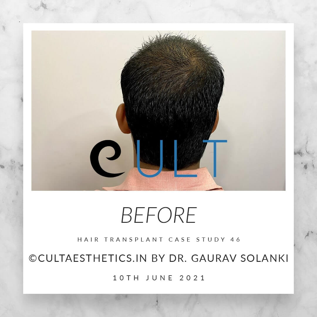 Hair Transplant Results at Cult Aesthetics 46
