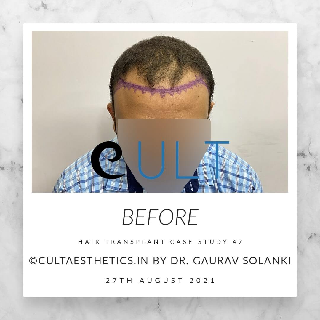 Hair Transplant Results at Cult Aesthetics 47