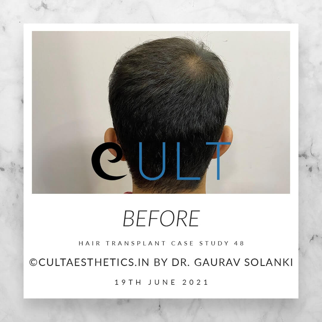 Hair Transplant Results at Cult Aesthetics 46