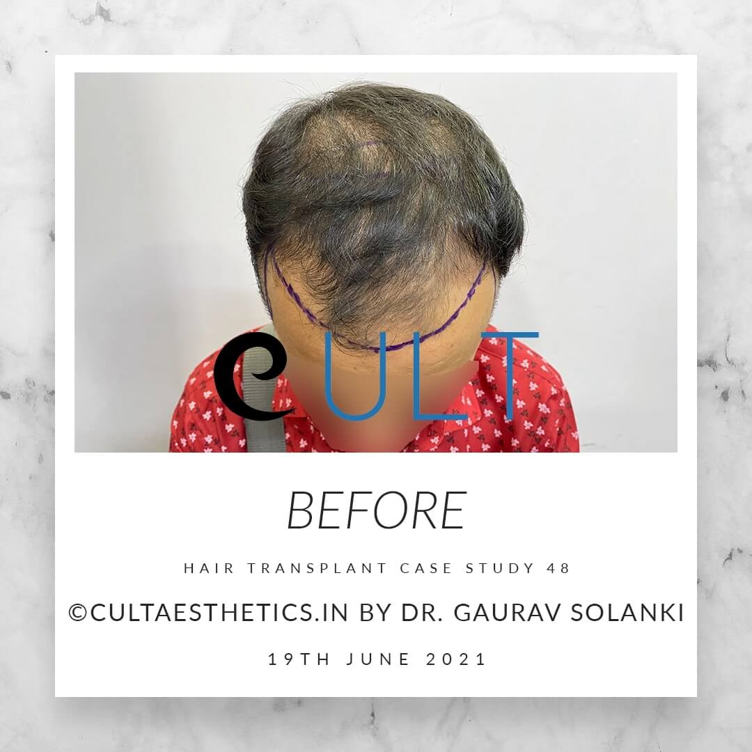 Hair Transplant Results at Cult Aesthetics 48
