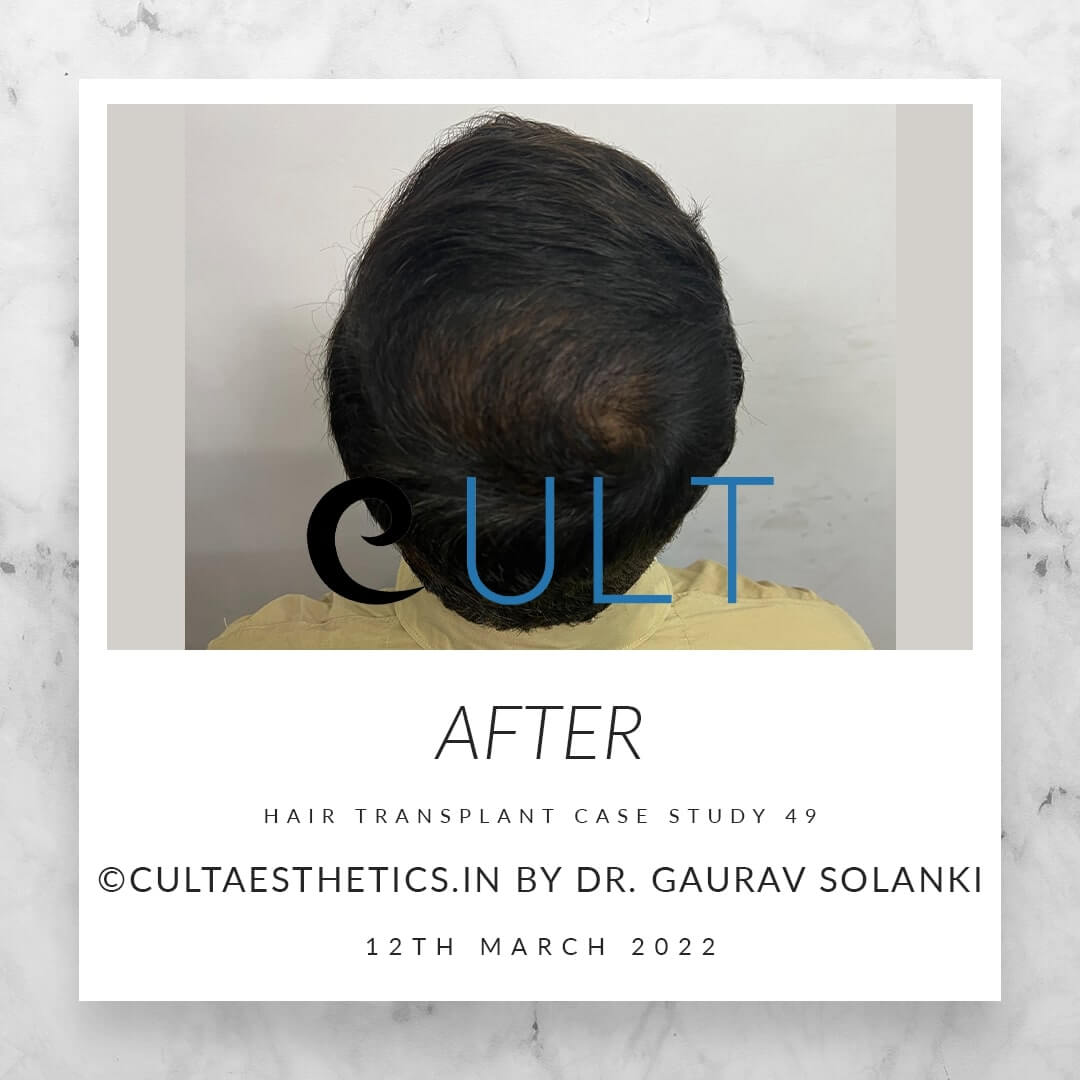 Hair Transplant Results at Cult Aesthetics 49