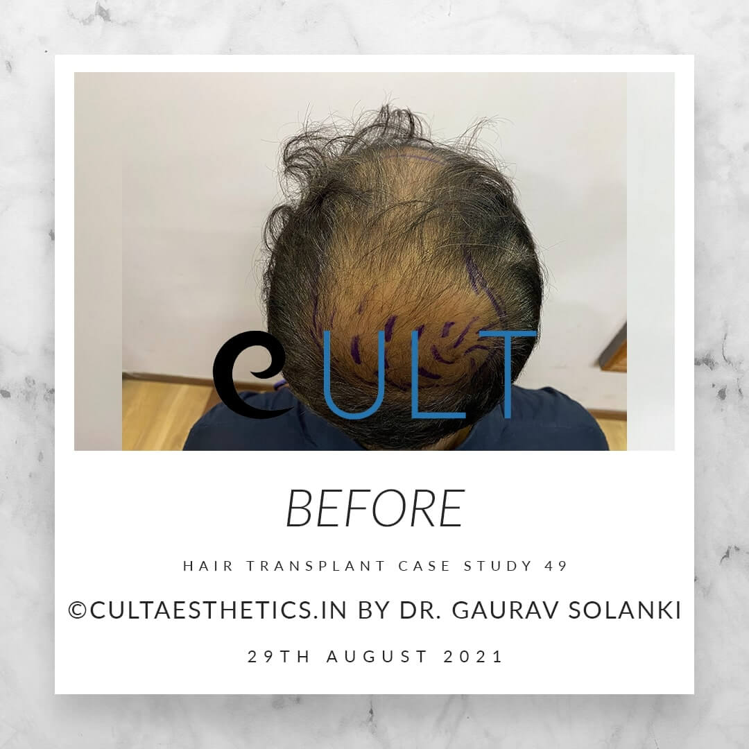 Hair Transplant Results at Cult Aesthetics 49
