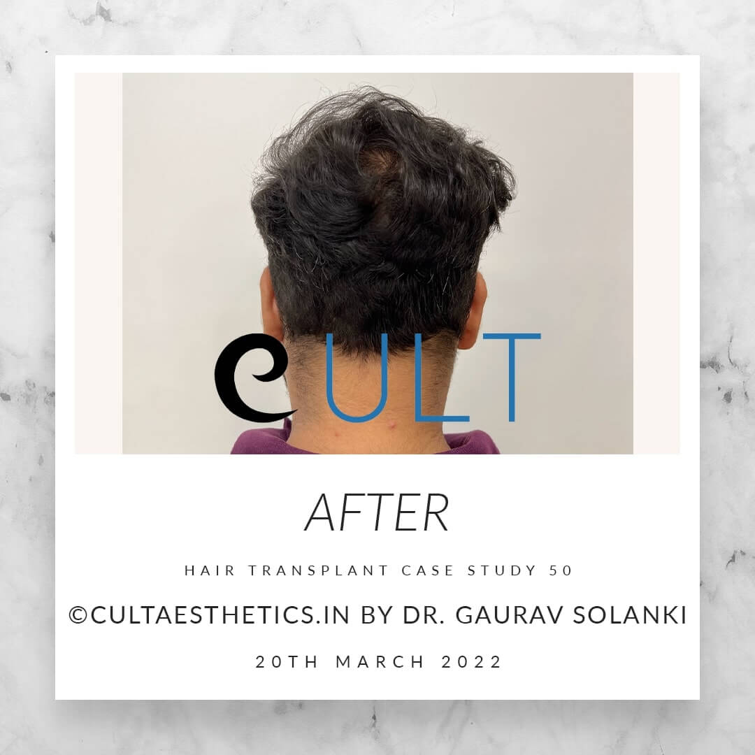 Hair Transplant Results at Cult Aesthetics 50