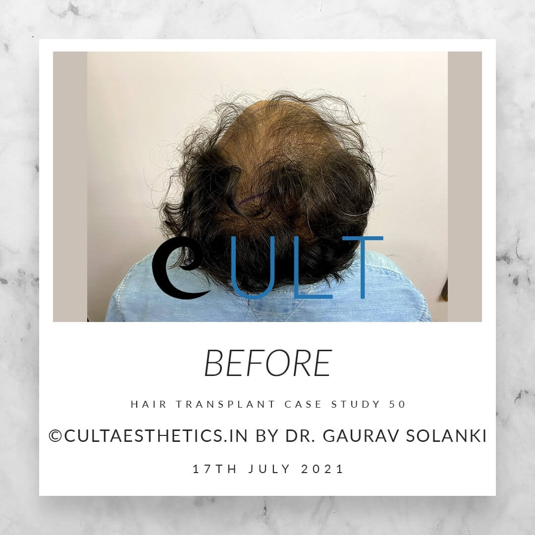 Hair Transplant Results at Cult Aesthetics 50