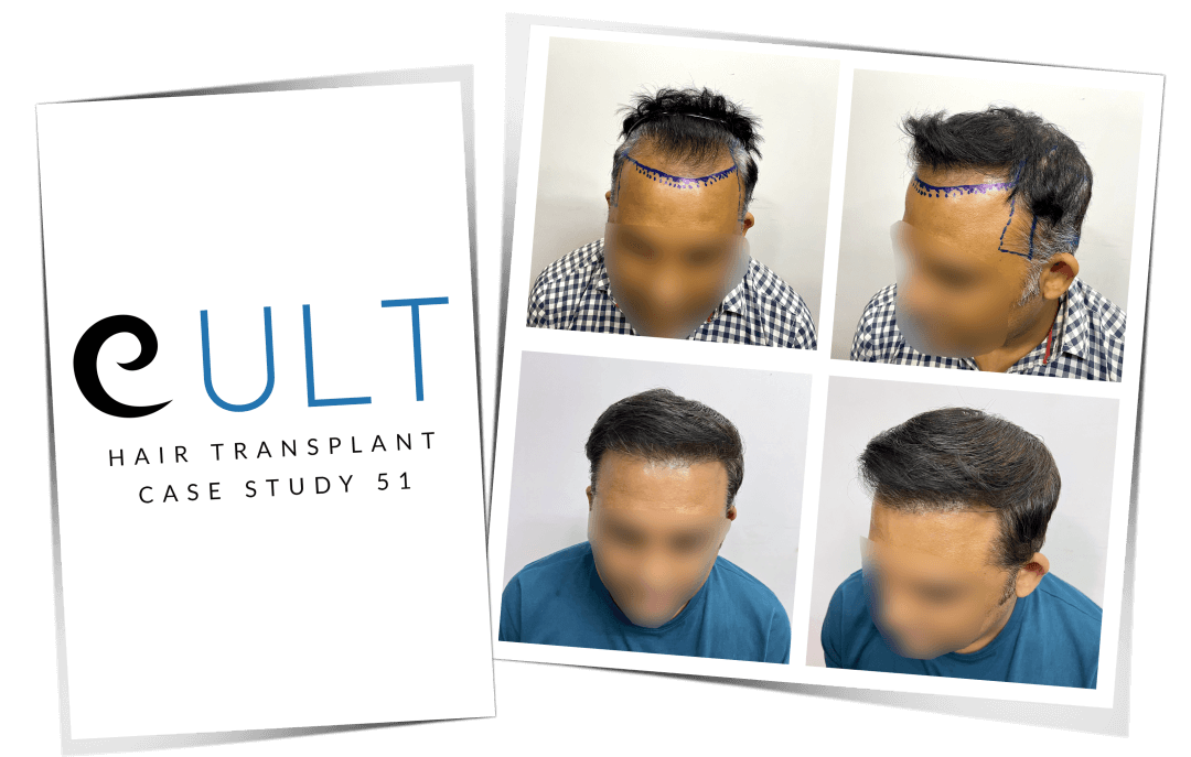 Hair Transplant Results at Cult Aesthetics 51