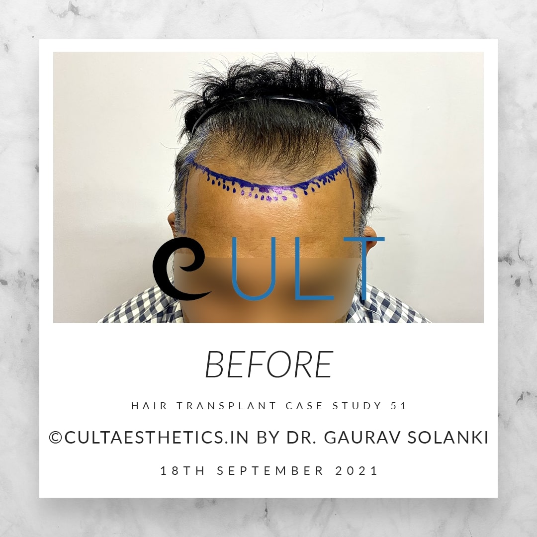 Hair Transplant Results at Cult Aesthetics 51