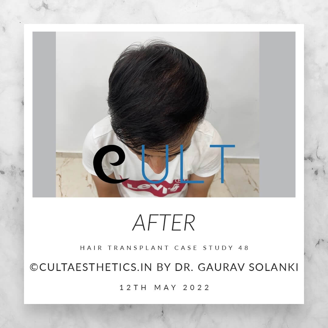 Hair Transplant Results at Cult Aesthetics 48
