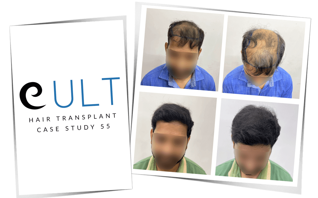 Hair Transplant Case 55 13
