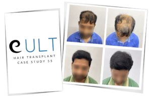 Hair transplant Case 55 before and after results by Dr Gaurav Solanki - Cult Aesthetics Gurgaon