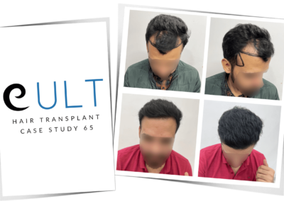 Hair Transplant Case Study 65 Cover