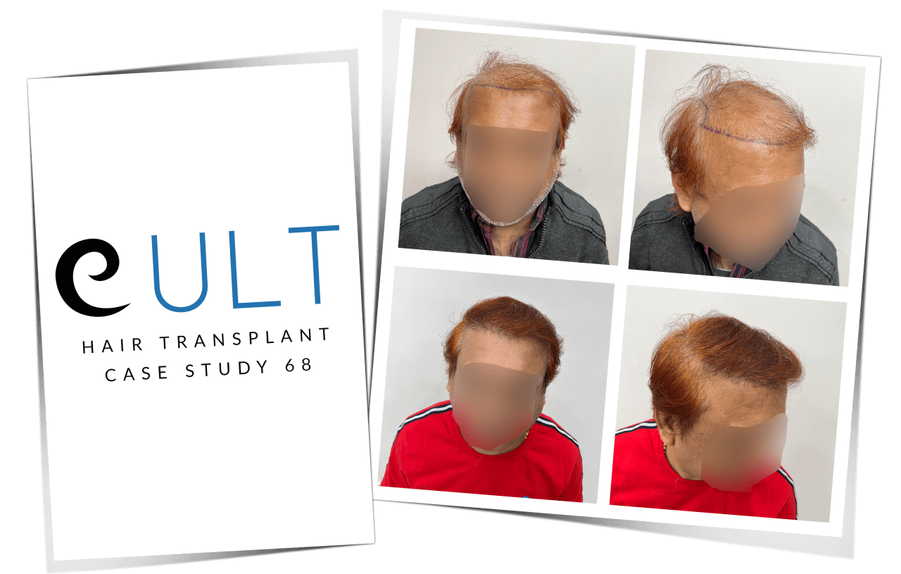 Hair Transplant Case Study 65 Cover