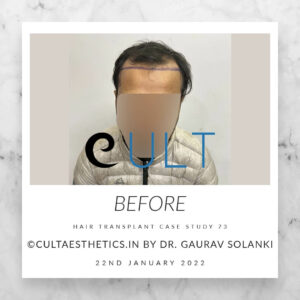 Hair Transplant Result 73 (12) - Hair Transplant Clinic in Gurgaon