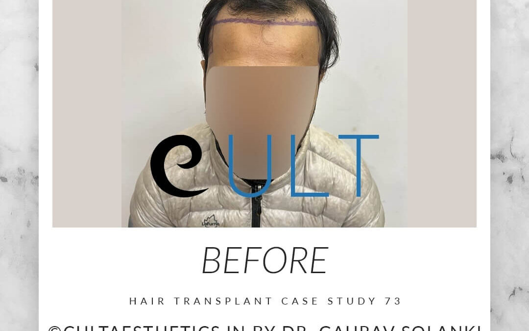 Hair Transplant Result 73 12