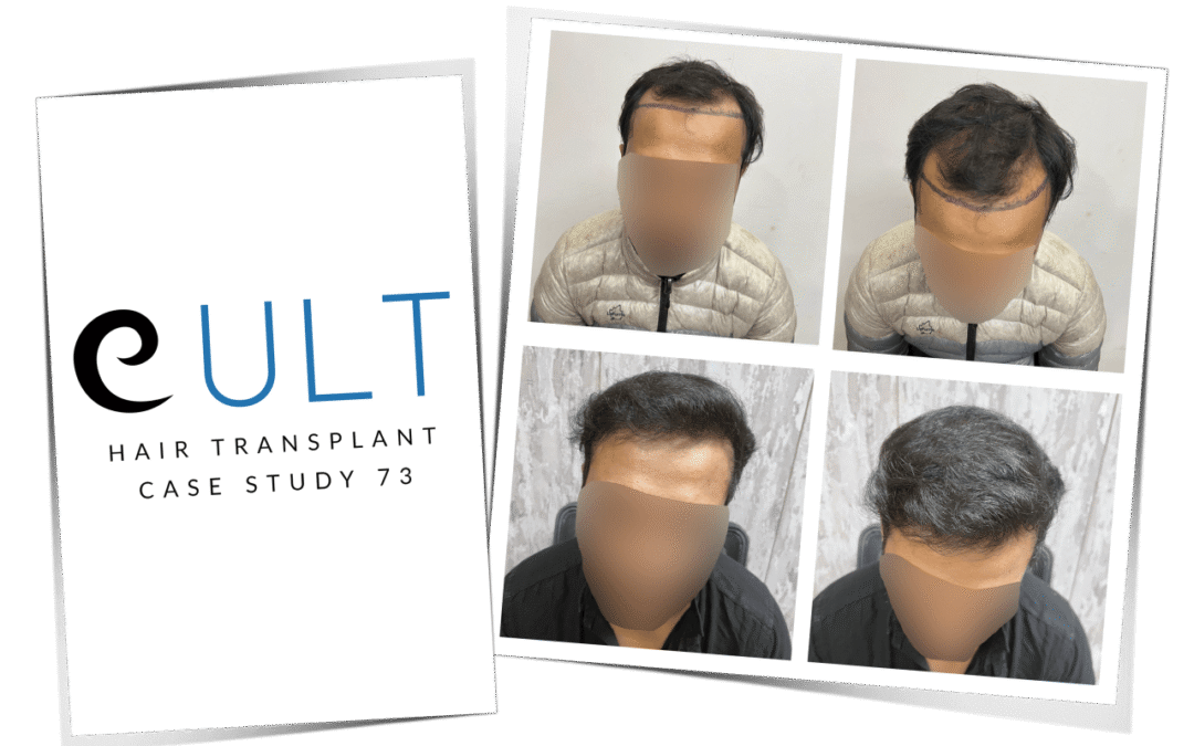 Hair Transplant Result 73