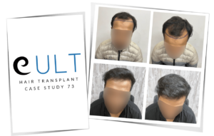 Hair Transplant Result 73 - Hair Transplant Clinic in Gurgaon