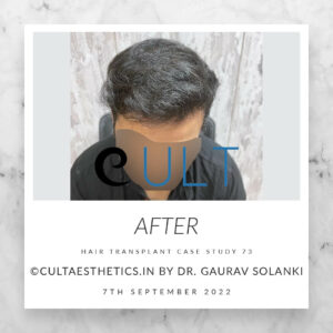 Hair Transplant Result 73 (5) - Hair Transplant Clinic in Gurgaon