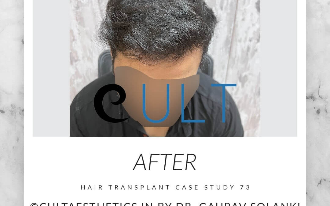 Hair Transplant Result 73 5