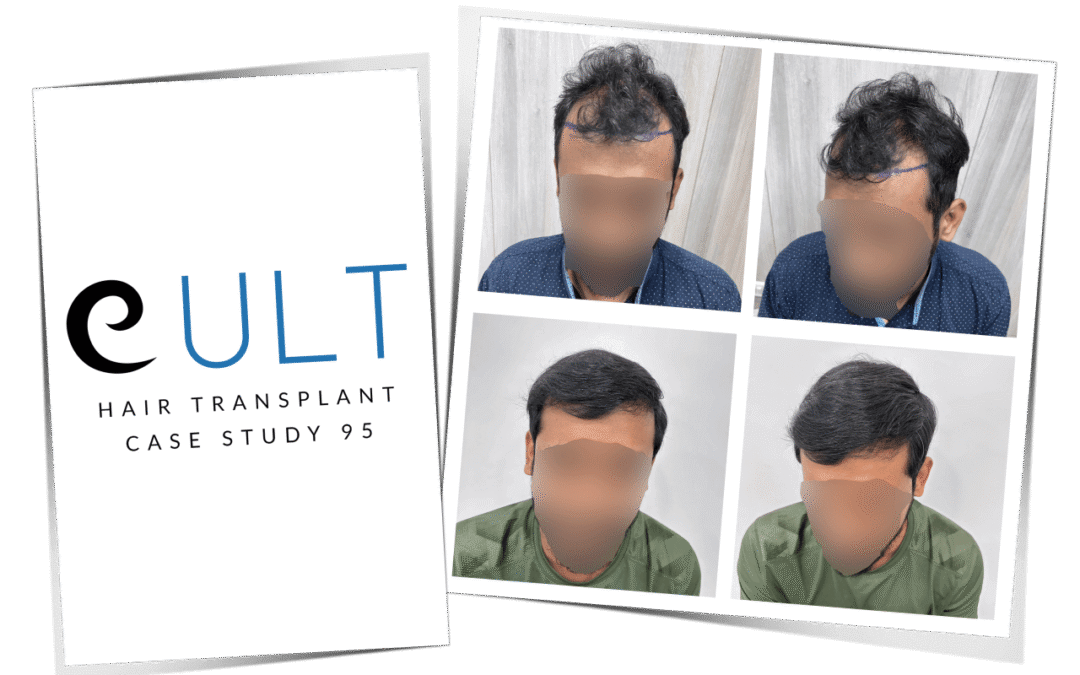 Hair Transplant Case 95 1